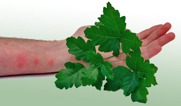 poison-oak-rash-600(1).jpg